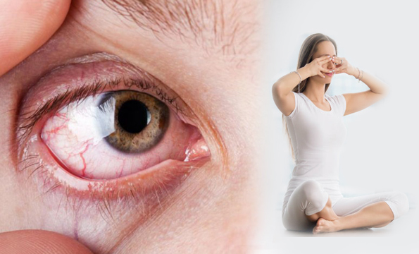 Eye StrainDry Eyes Yoga Therapy