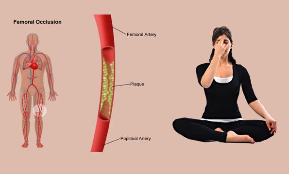 How Does Yoga Help In Post Bypass Surgery