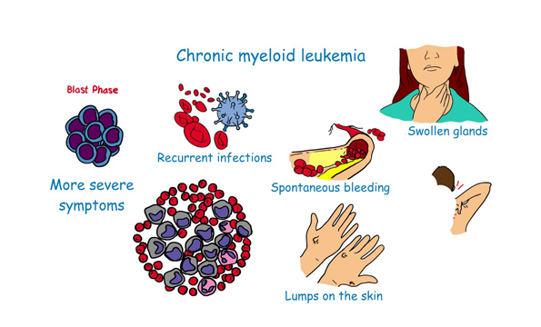 LEUKEMIA CML