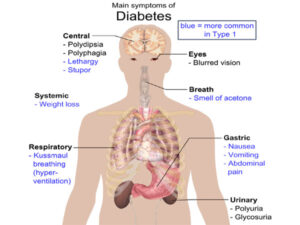 DIABETES MELLITUS